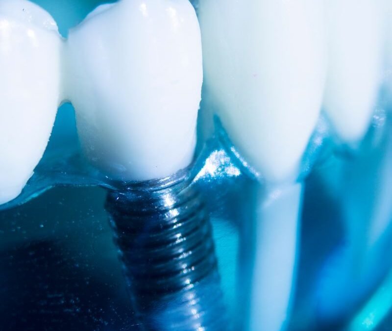 ¿Implantes Dentales Baratos o Económicos? ¡Lo Que Debes Saber!